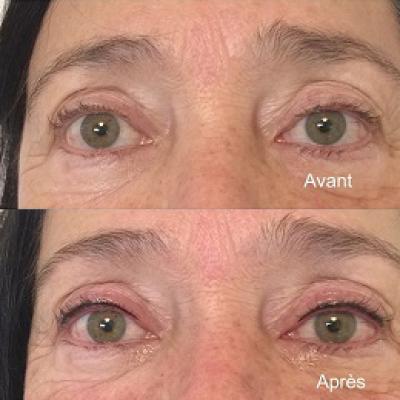 Yeux 1